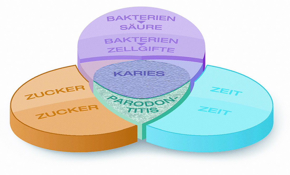 Entstehung von Karies und Zahnfleischentzündungen